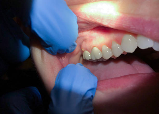 Best Emergency Dental Care for Sports Injuries in St Paul, MN